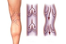 vere väljavool veenilaiendites haiguse arengu erinevatel etappidel